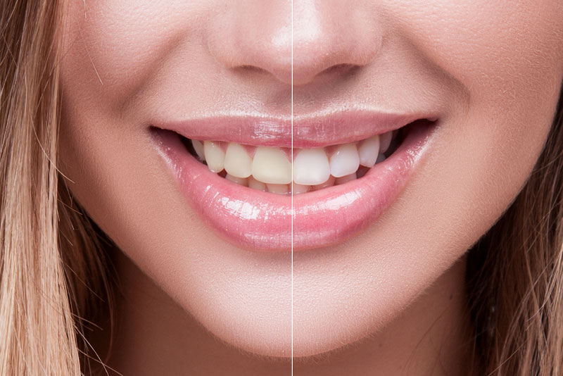 teeth whitening before and after