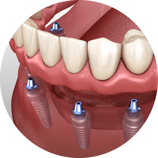 implant supported denture