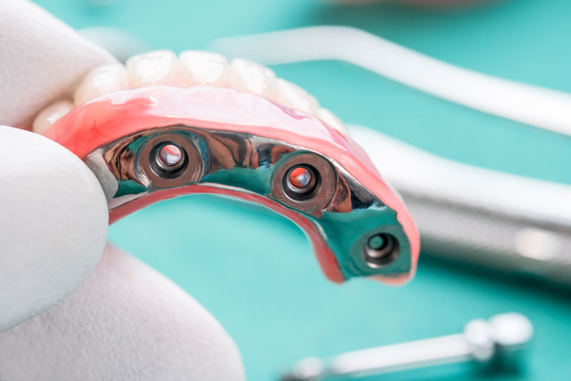 a dentist holding a full mouth dental implant model.