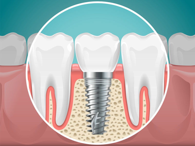 2d graphic of a single dental implant between two natural teeth.
