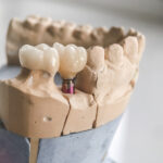 a full mouth dental implant mold model for those that need a full arch dental implant option.