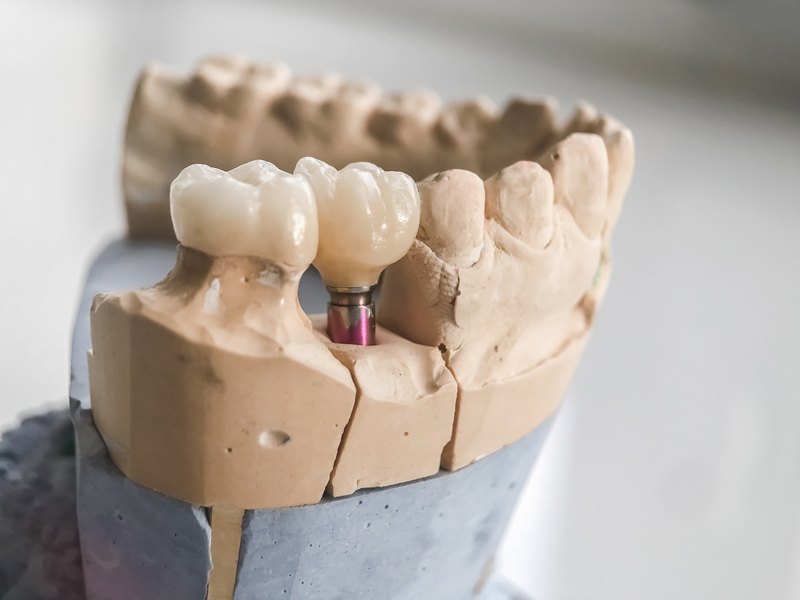 a full mouth dental implant mold model for those that need a full arch dental implant option.