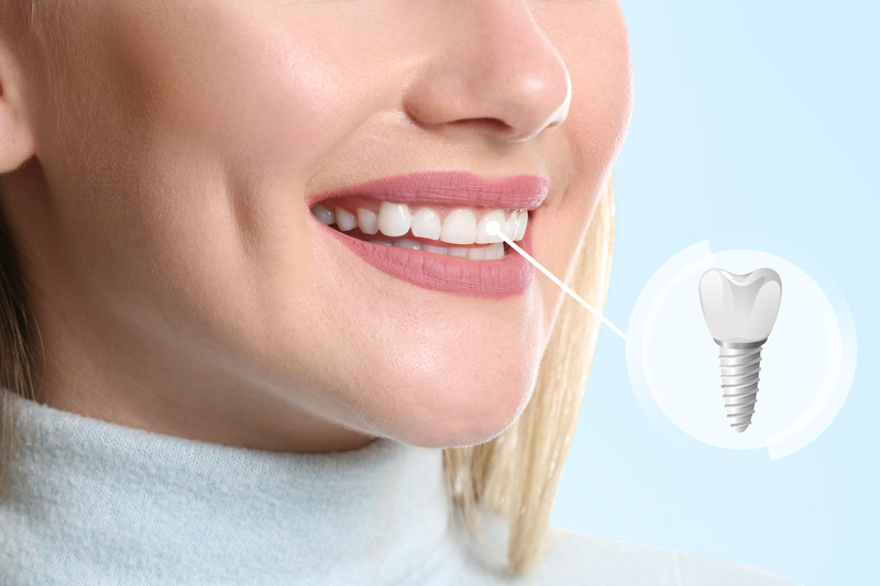 Young woman with implanted teeth on color background, closeup.