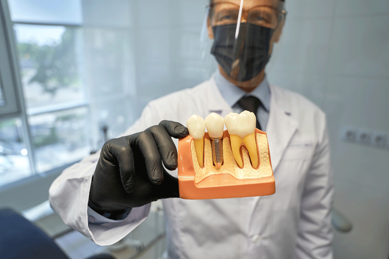 Doctor holding a model of a dental implant.
